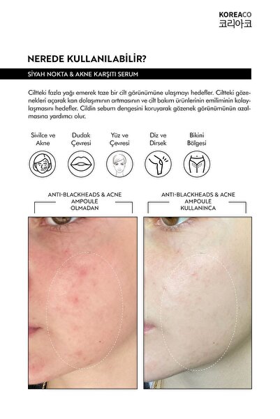 KOREACO Anti-Blackheads Acne Ampoule Siyah Nokta ve Akne Ampulü