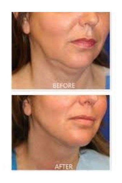 Generic Brand Lipo Mesotherapy - Double Chin Melting and Cheek Biblication [1 Vial 5ml]