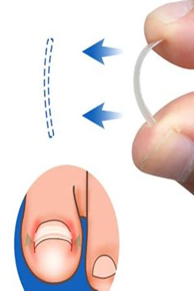 Dia Batık Tırnak Bandı (10 ADET) Yapıştırıcı