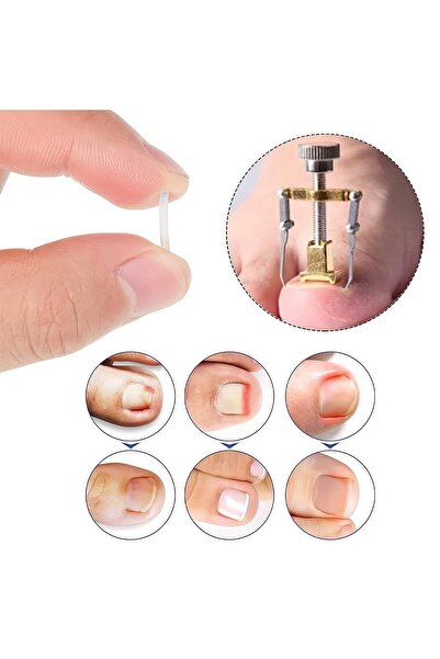 Rabadon Batık Tırnak Düzeltme Aleti Batık Tırnak Çıkartıcı Aparat Ayak Tırnak...