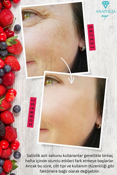 Anatolia Soap Zero Pore Salicylic Acid Soap Bha Peeling Blackhead Purifying Revitalizing Renewing