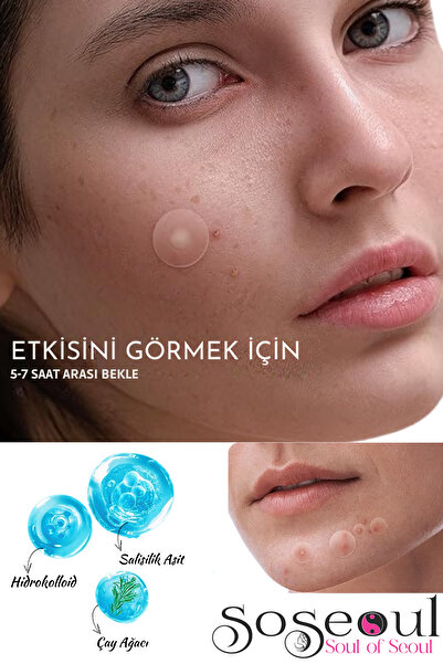 SoSeoul Anti Pimple Patch Çay Çiçeği Ve Salisilik Asit Özlü Anti Acne Set 72'li Sivilce Bandı