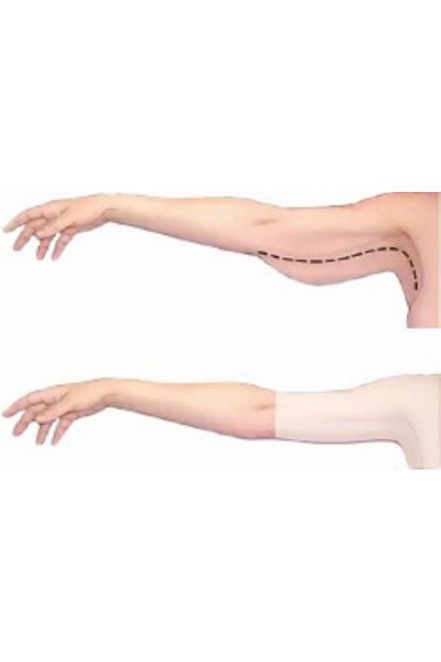 Yeniİnci Corse for Arm and Back