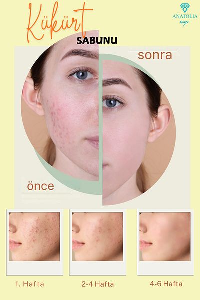 Anatolia Soap Anti-Acne Sulfur Soap - Solution for Oily Skin and Pimples Cleans Pores