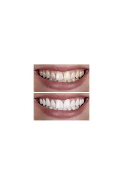 qartz Teeth Whitening and Polishing Paste 20 Pieces
