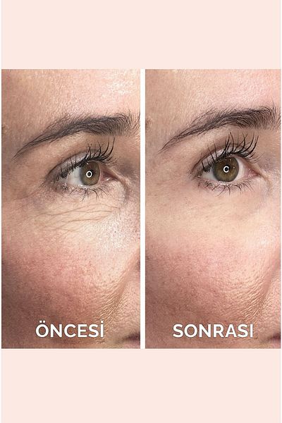 VITAYES Acetyl Hexapeptide-8 Face Cream and Under-eye Bags - Instantly Effective Firming