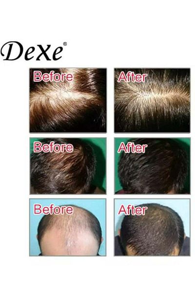 Dexe Anti-hair Loss Lotion Spray 120ml