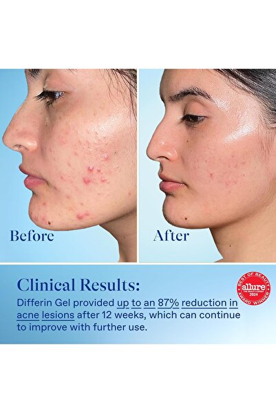 Differin Acne Treatment Gel with 0.1% Adapalene Gel 45 gm