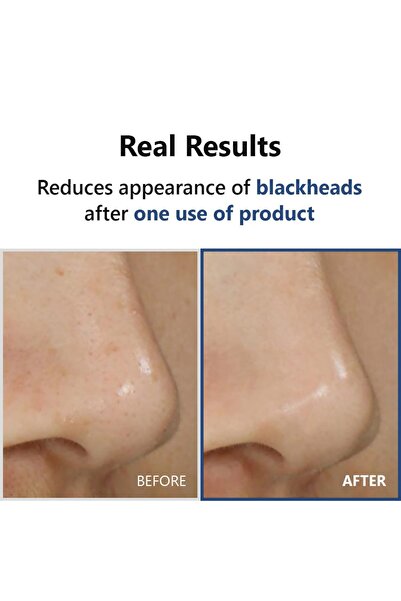 Isntree ISNTREE Hyper Acid 4 Serum 20ml | Gentle Chemical Exfoliant | Korean Skincare