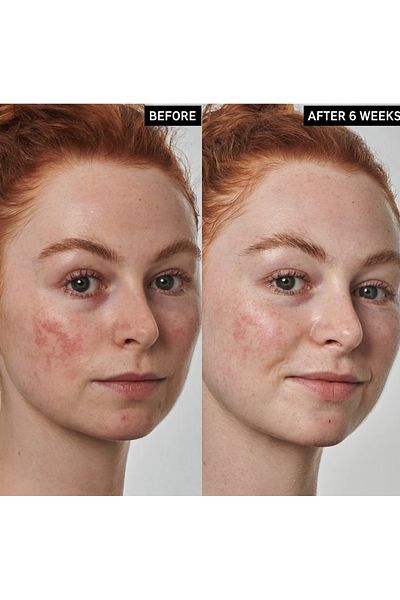 THE INKEY LIST Redness Solution with 10% Azelaic - Face Serum