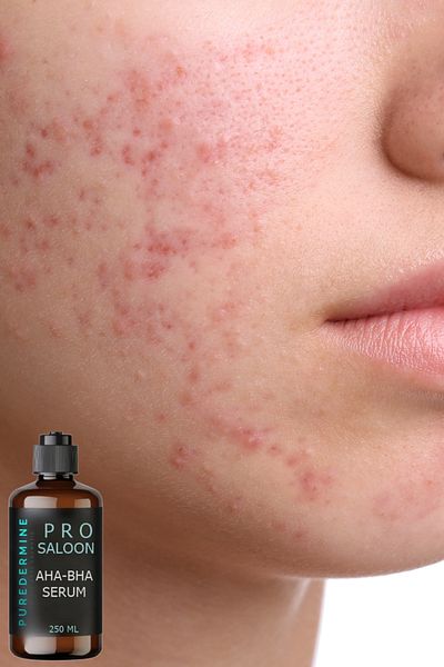 Puredermine Aha & Bha Serum Removes Dark Spots + Dark Spots + Pores + Mild Chemical Peeling