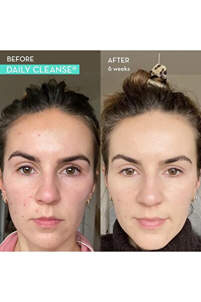 HUM Clear Skin Daily Cleanse Acne Supplement with Algae, Herbs, Zinc & Spirulina - 60 Caps