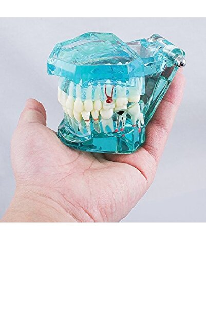 Fantom implant fantom çene mavi