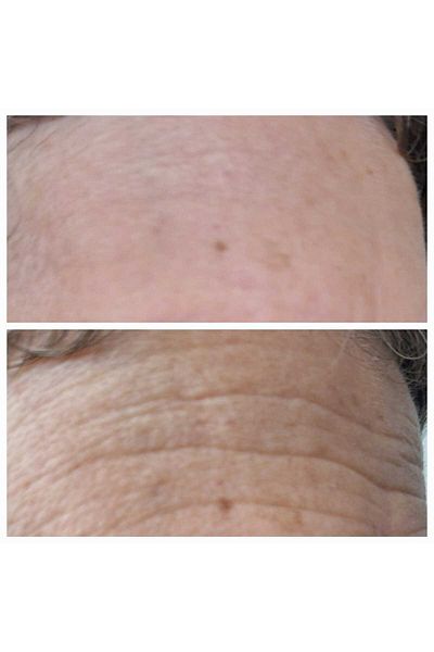 xaura Permanent Botox Effect Anti-Aging Cream with 8 Million Microneedles, Contains 24K 1000 Ppm Gold,