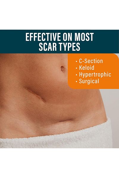 dermis NUVADERMIS Silicone Scar Sheets - Extra Long Surgical Scars - Reusable -Pack of 4