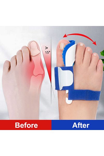 Choice 1 Pair Bunion Device Hallux Valgus Orthopedic Braces Toe Correction Night Foot Care Corrector Thu...
