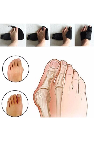 Genel Markalar Medikal Halluks Valgus Gece Ateli Ayak Baş Parmak Bunyon Koruyucu 1 Çift (SAĞ VE SOL)(gece Ateli Ex-