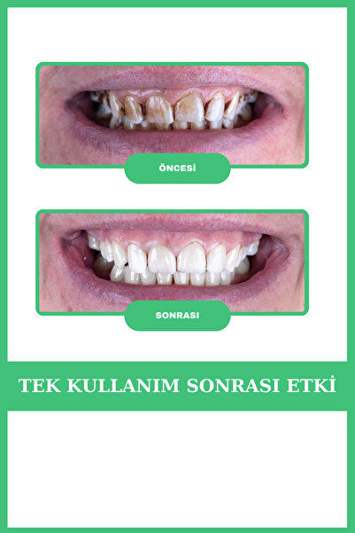 AVANT DENTAL SUPPLY 3 Tüp Diş Beyazlatıcı Nane Aromalı Sigara Çay Kahve Lekesi Için Profesyonel Bakım(3 AYLIK)