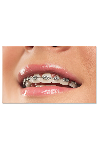 StoryGift Romania Tablou Canvas - Zambet Metalic: Frumusete, Aparate Ortodontice, Sanatate Orala