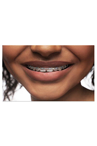 StoryGift Romania Tablou Canvas - Zambet Stralucitor: Femeie Neagra, Aparat Dentar, Igiena Orala