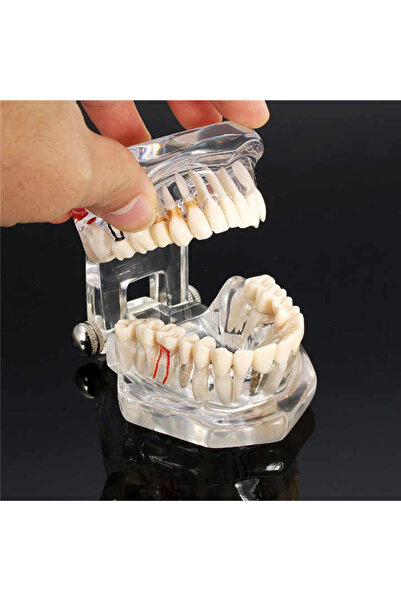 OEM Diş Implant Hastalığı Diş Modeli Ile Restorasyon Köprü Malocclusion