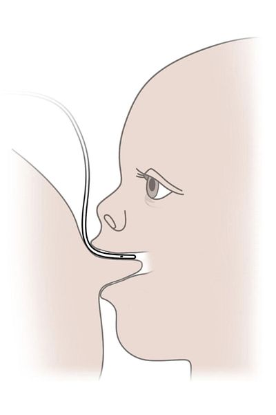 Bıçakçılar Breastfeeding Support System No:10 Feeding Probe Black Eds Fixing Tape and Locked Injector Gift