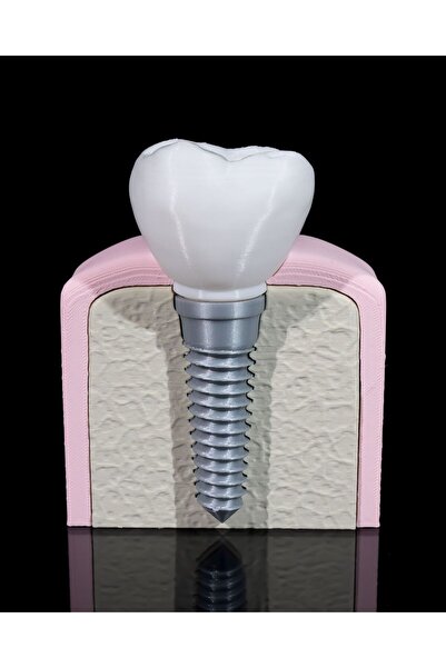 Xeir Decoration Diş İmplant Eğitim Maketi – Anatomik Model – Vida Tipi Protez...