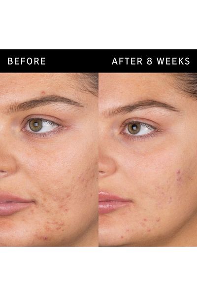 THE INKEY LIST Salicylic Acid Cleanser 150ml – Deep-Cleansing Face Wash for Acne & Oily Skin