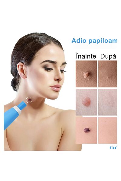 QuTek Kit Indepartare Papiloame QuTek- Dispozitiv Ligaturare 2-8mm, 40 Benzi Cauciuc, 36 plasturi