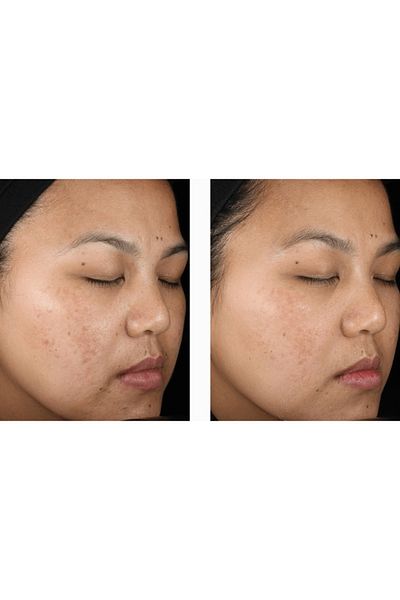 Menarini Gel, A-Ret, Menarini, Anti-Rid, Anti-Acne, Anti-Pete, Tretinoin 0.05%, Tub 20gr