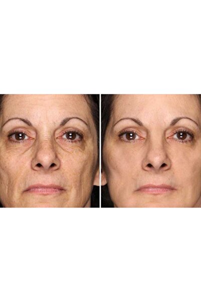 Menarini Gel, A-Ret, Menarini, Anti-Rid, Anti-Acne, Anti-Pete, Tretinoin 0,05%, Μπανιέρα 20γρ.