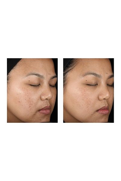 Menarini Gel, Menarini, A-Ret, A-Ret, Anti-Acne, Anti-Rid, Tretinoin 0.1%, 20gr