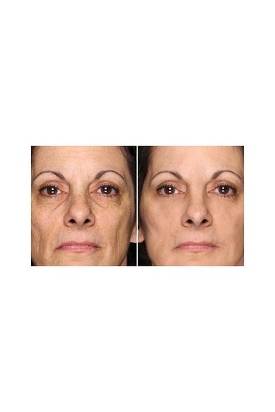 Menarini Gel, Menarini, A-Ret, A-Ret, Anti-Acne, Anti-Rid, Tretinoin 0.025%, 20gr