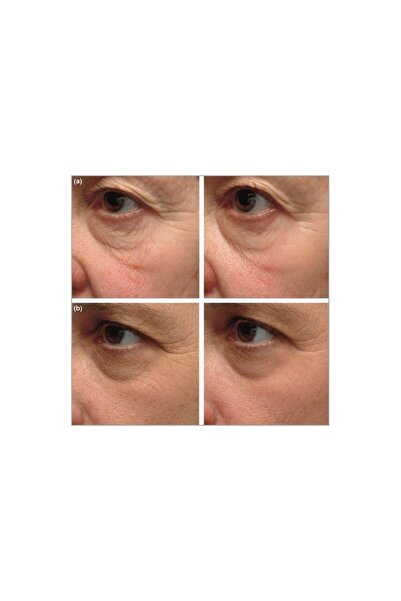 Menarini Τζελ, Menarini, A-Ret, A-Ret, Κατά της Ακμής, Κατά της Ρίγης, Τρετινοΐνη 0.1%, 20γρ