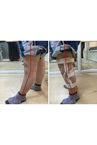 KARMA Grup Ortopedi Karma Grup Genu Rekurvatum Dizlik İsveç Diz Ortezi