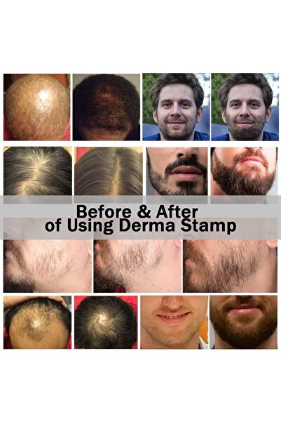 Drs Derma Stamp System ديرما ستامب - جهاز الوخز بالإبر الدقيقة للعناية بالبشرة والشعر