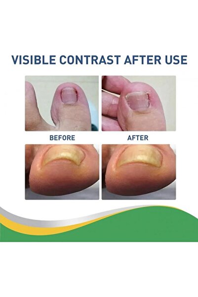 Genel Markalar 30 Adet Ayak Tırnağı Düzeltme Bandı Seti, Sağlıklı Tırnaklar i...