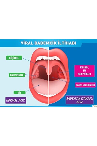 okulcenter Bademcik Iltihabı Afişi (vinil) 50x70 Cm