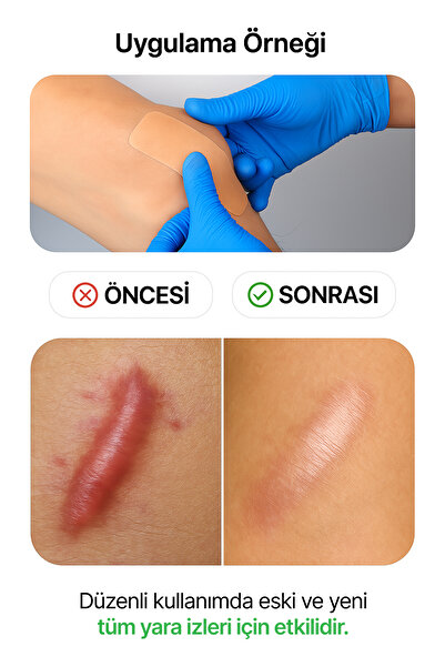 luofucon Silikon Jel Iz Giderici Bant Akne Lezyon Skar Keloid Cilt Çatlakları Ameliyat Izi Giderici (5X20CM)