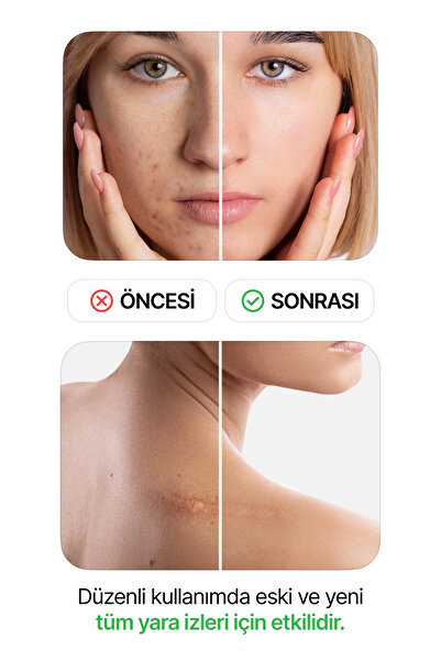 luofucon Estetik Yanık Sezaryen Dikiş Izi Keloid Ameliyat Izi Giderici Soft Silikon Bant 2,5cm X 3mt