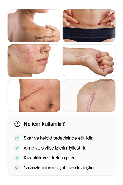 luofucon Silikon Jel Iz Giderici Bant Akne Lezyon Skar Keloid Cilt Çatlakları Ameliyat Izi Giderici (5X20CM)