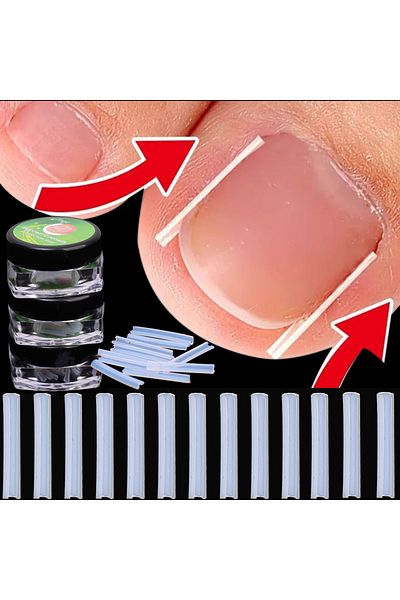 LOVYCO Ingrown Nail Corrector Plastic Strips 10 Pieces