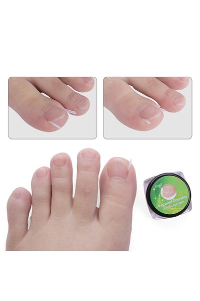 LOVYCO Ingrown Nail Corrector Plastic Strips 10 Pieces