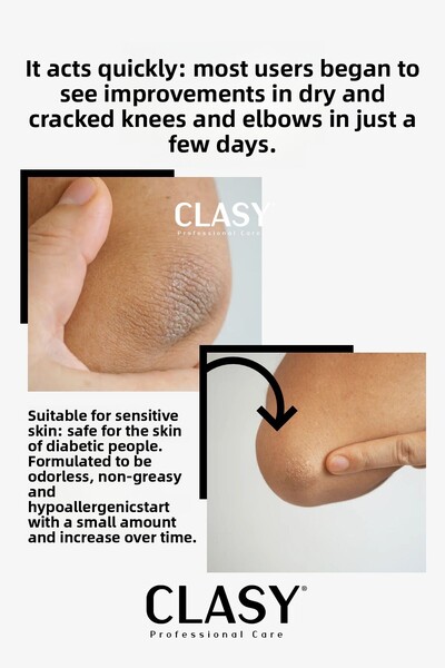 Clasy Care Hand, Knee and Elbow Care Cream - Against Chapped, Dry, Darkened Hard Skin