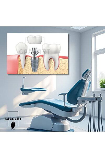 GAAGART Tekli Yatay Kanvas Diş Poliklinik Tablosu İmplant ve Dişler