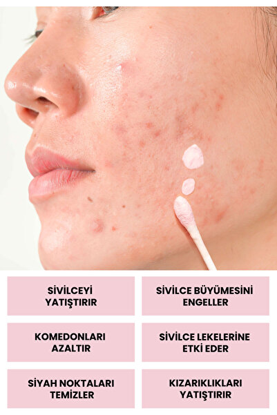 Luv it! Sivilce ve Akne Karşıtı Losyon 30ml – Salisilik Asit Içeren Kurutucu