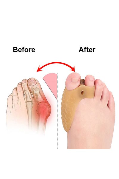 Choice Pexmen 2Pcs Bunion Corrector Toe Separators Hallux Valgus Soft Gel Bunion Pads Support for Overla...