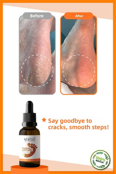 Wyess New Effective Formula Foot and Heel Crack Care Oil Premium A-Quality 30 ml