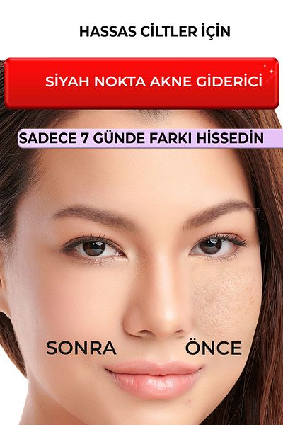 Devida Blackhead Acne Remover Pore Tightening Vivo Series A210