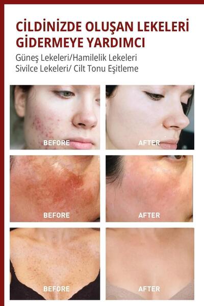 golden veil Leke,giderici Koltuk Altı-diz-dirsek Ve Bikini Bölgesi Cilt Beyaz...